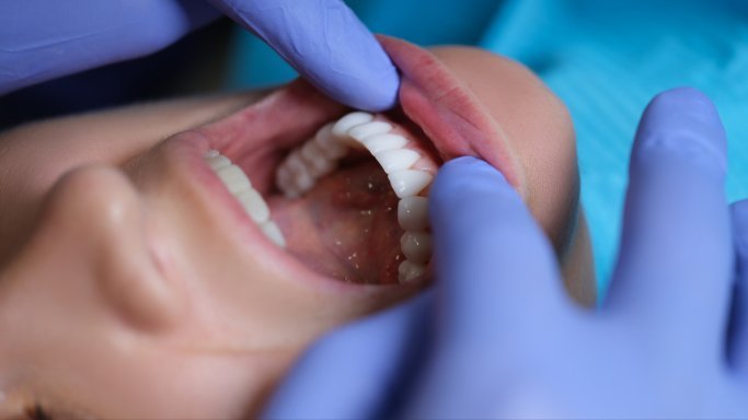 Mouth Breathing vs. Nasal Breathing: The Impact on Oral Health - Titan Recovery